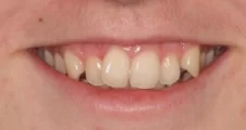 Teen fixed braces crooked teeth before treatment smile Fareham