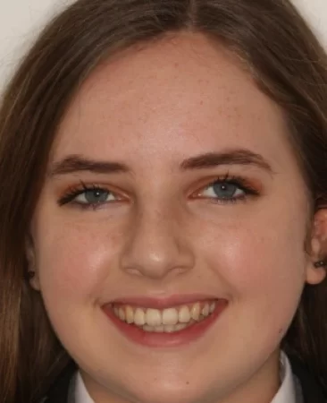Teen fixed braces crowded teeth after treatment with straightened smile face Fareham