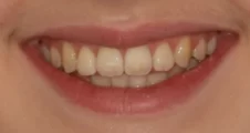 Teen fixed braces crowded teeth after treatment with straightened smile Fareham