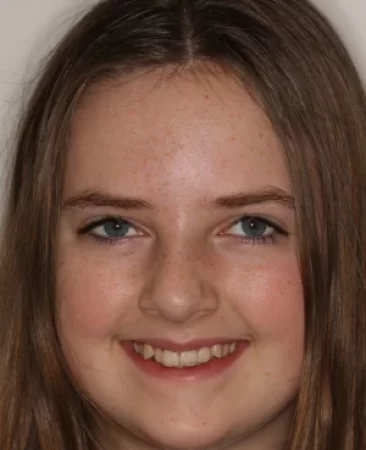 Teen fixed braces crowded teeth before treatment face Fareham