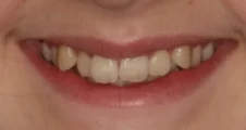 Teen fixed braces crowded teeth before treatment smile Fareham