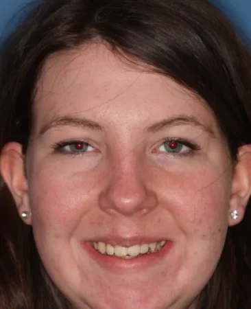 Teen fixed braces crooked teeth after treatment with straightened smile face Fareham