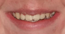 Teen fixed braces crooked teeth after treatment with straightened smile Fareham