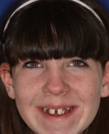 Teen fixed braces crowded teeth before treatment face Fareham