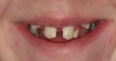 Teen fixed braces crowded teeth before treatment smile Fareham