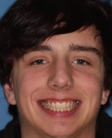 Teen functional appliance and fixed braces deep bite after treatment with improved bite face Fareham