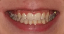 Teen functional appliance and fixed braces deep bite after treatment with improved bite smileFareham