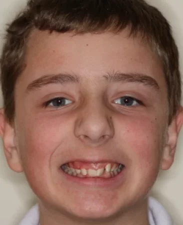 Teen fixed braces deep bite before treatment face Fareham