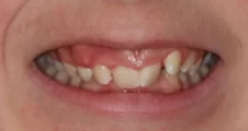 Teen fixed braces deep bite before treatment smile Fareham