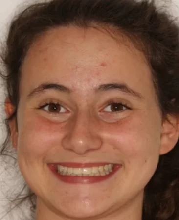 Teen fixed braces impacted canines and crowded teeth after treatment with aligned teeth face Fareham