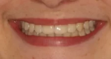 Teen fixed braces impacted canines and crowded teeth after treatment with aligned teeth smile Fareham