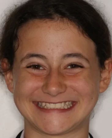 Teen fixed braces impacted canines and crowded teeth before treatment face Fareham