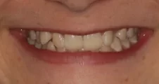 Teen fixed braces crowded teeth and impacted canines before treatment smile Fareham