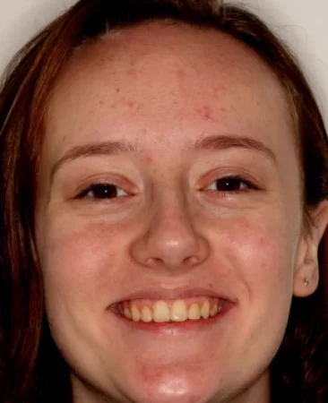 Teen fixed braces impacted canines and crowded teeth after treatment with aligned teeth face Fareham