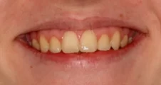 Teen fixed braces impacted canines and crowded teeth after treatment with aligned teeth face Fareham