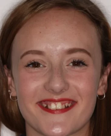 Teen fixed braces impacted canines and crowded teeth before treatment face Fareham