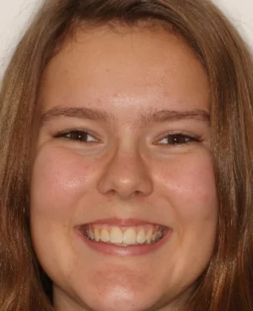 Teen fixed braces narrow smile after treatment with broader smile face Fareham