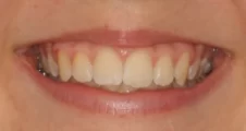 Teen fixed braces narrow smile after treatment with broader smile Fareham