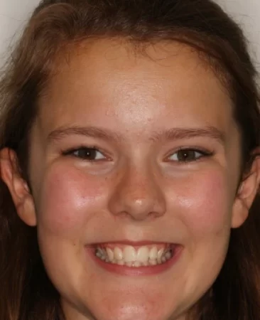 Teen fixed braces narrow smile before treatment face Fareham