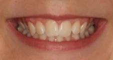 Teen fixed braces narrow smile before treatment Fareham