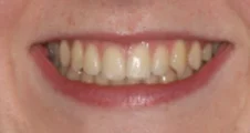 Teen fixed braces narrow smile after treatment with broader smile Fareham