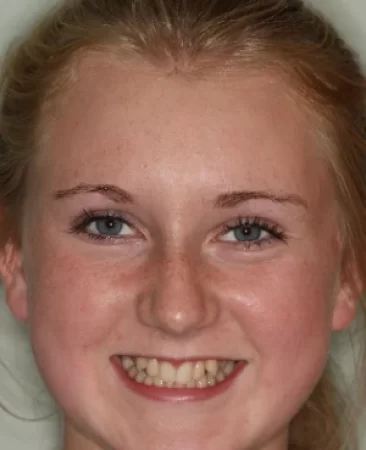 Teen fixed braces narrow smile before treatment faceFareham