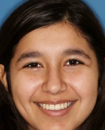 Teen functional appliance fixed braces teeth sticking out after treatment with improved alignment face Fareham