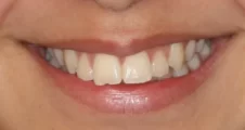 Teen functional appliance fixed braces teeth sticking out before treatment smile Fareham