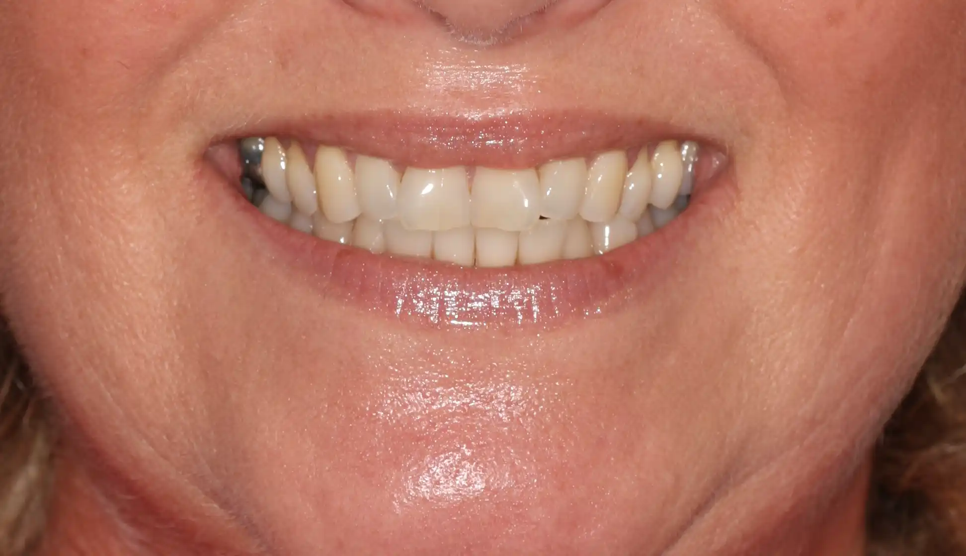 adult crowded teeth before invisalign treatment specialist orthodontist fareham