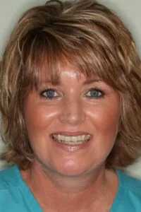 adult female wearing invisalign aligners and smiling as they are comfortable